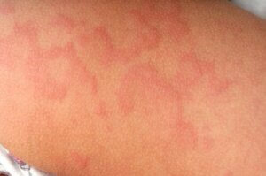 Erythema Nodosum in Children: Symptoms, Causes and Treatment