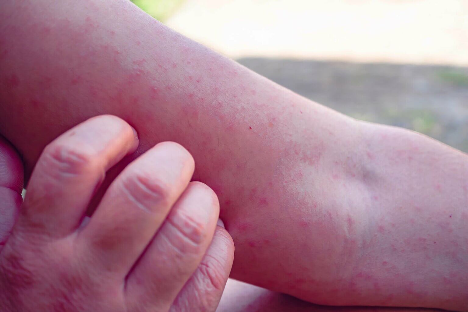 Erythema Nodosum in Children Symptoms, Causes and Treatment