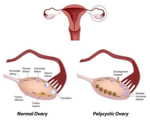 Diet and Polycystic Ovary Syndrome