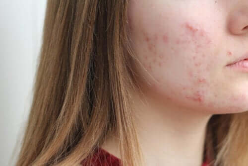Food and Acne: What You Eat Matters