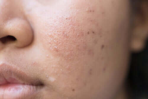 Food and Acne: What You Eat Matters