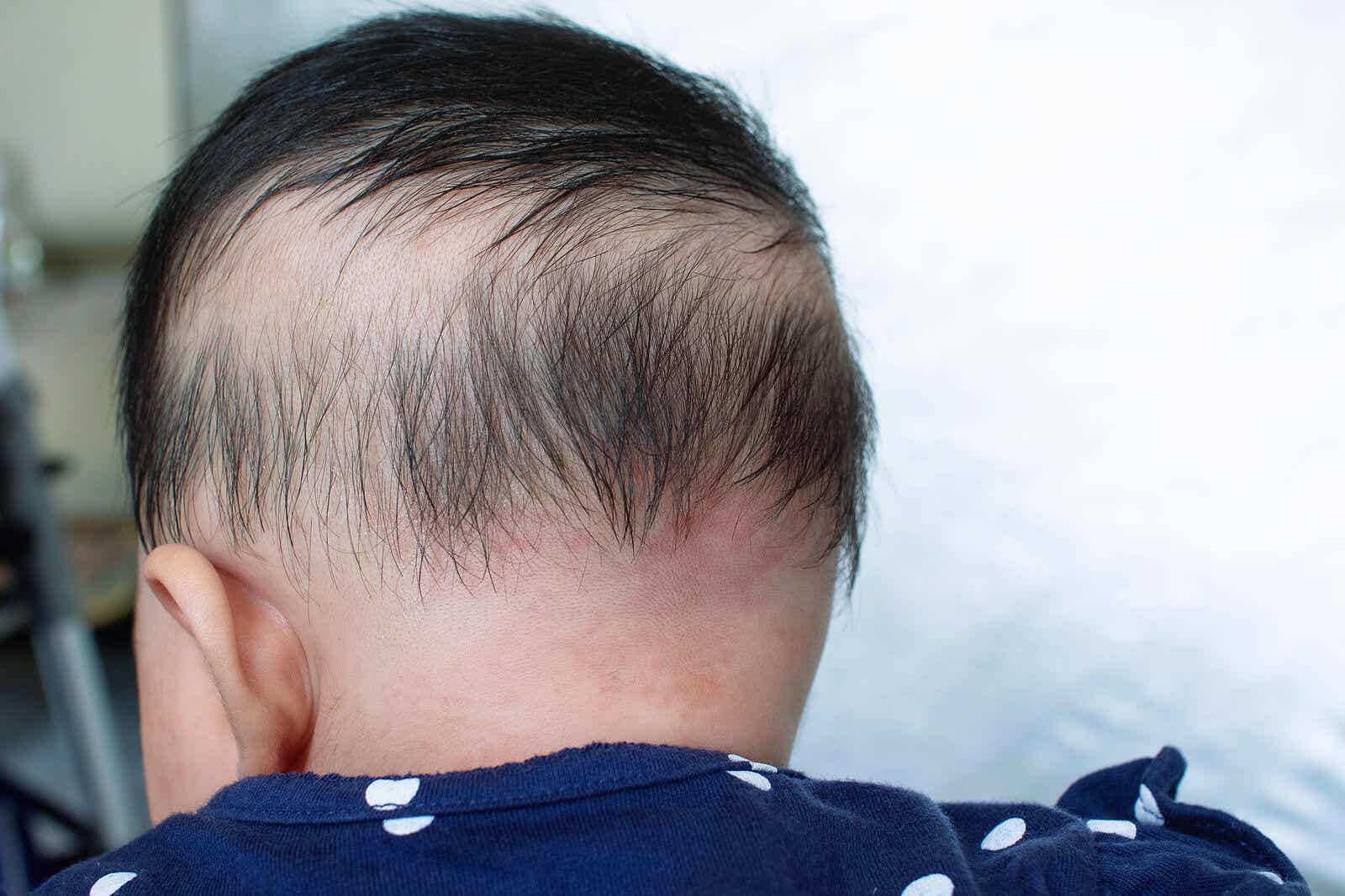 Scalp infection.