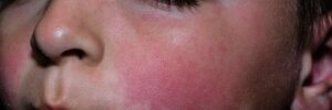 Fifth Disease in Children: What You Should Know