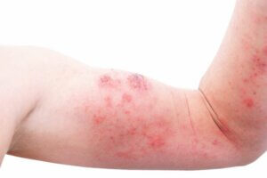 10 Types of Dermatitis in Children