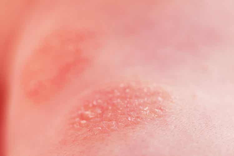 10 Types of Dermatitis in Children