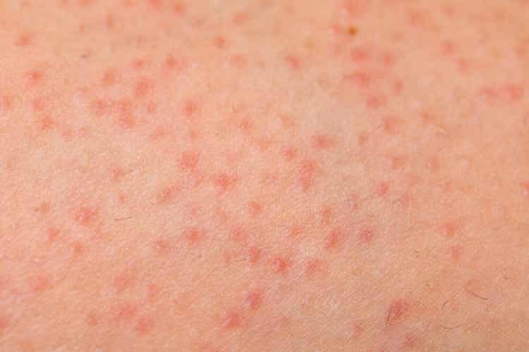 Keratosis Pilaris in Children: Symptoms, Causes and Treatment