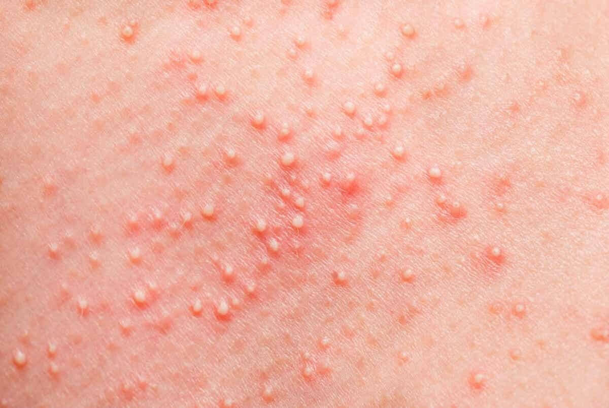 Miliaria or sweat rash in infants.