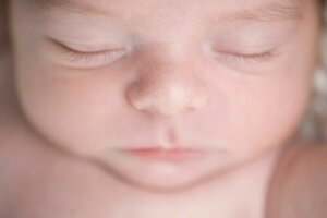 Miliaria or Sweat Rash in Infants: What Is It?