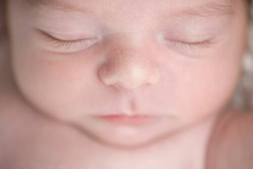 Miliaria or Sweat Rash in Infants: What Is It?