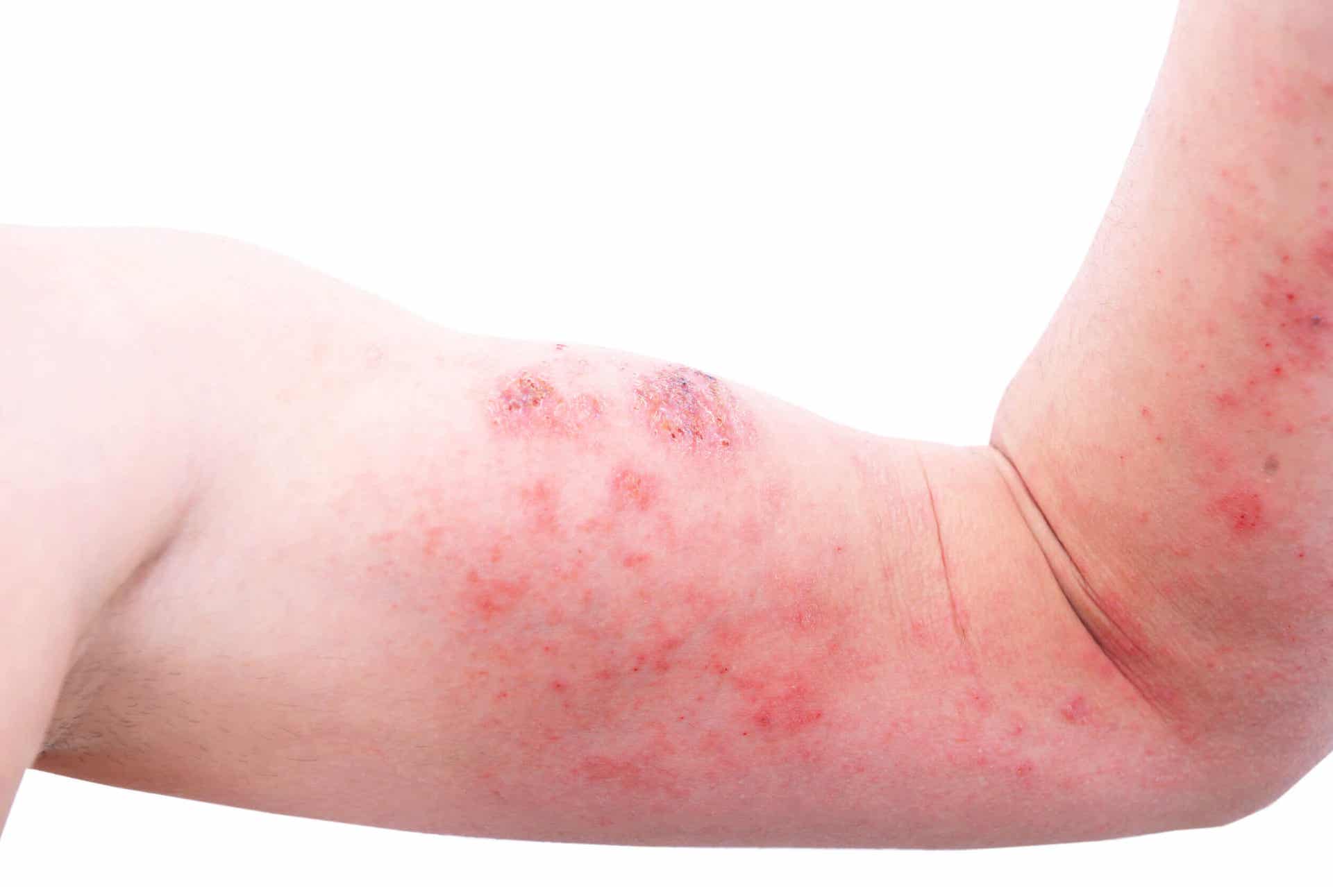 Meer informatie over atopische dermatitis.