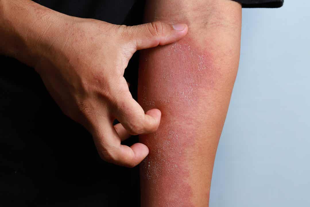 Een man die een grote uitslag op zijn arm krabt.