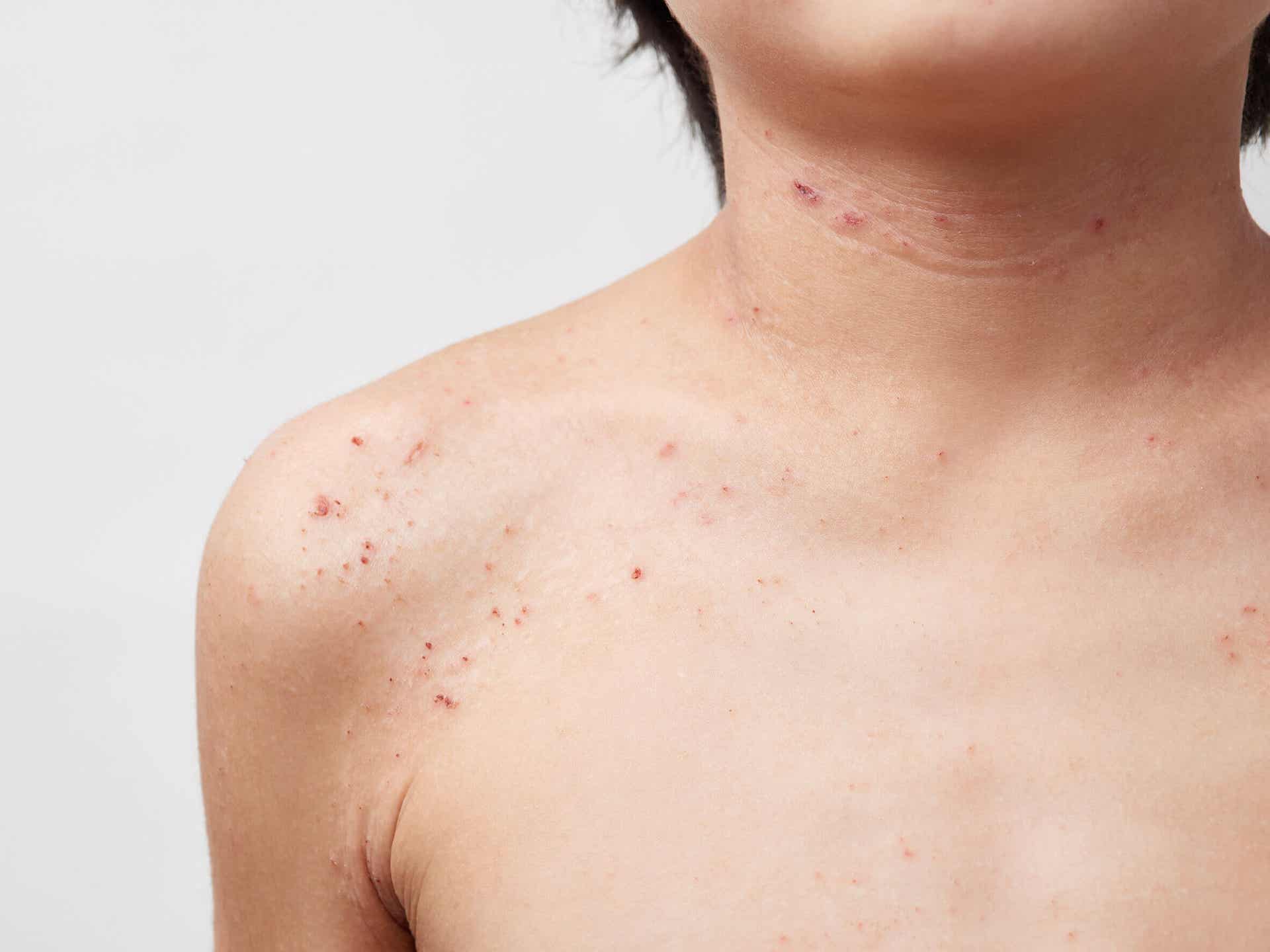 Een jonge jongen met atopische dermatitis op zijn nek en schouders.