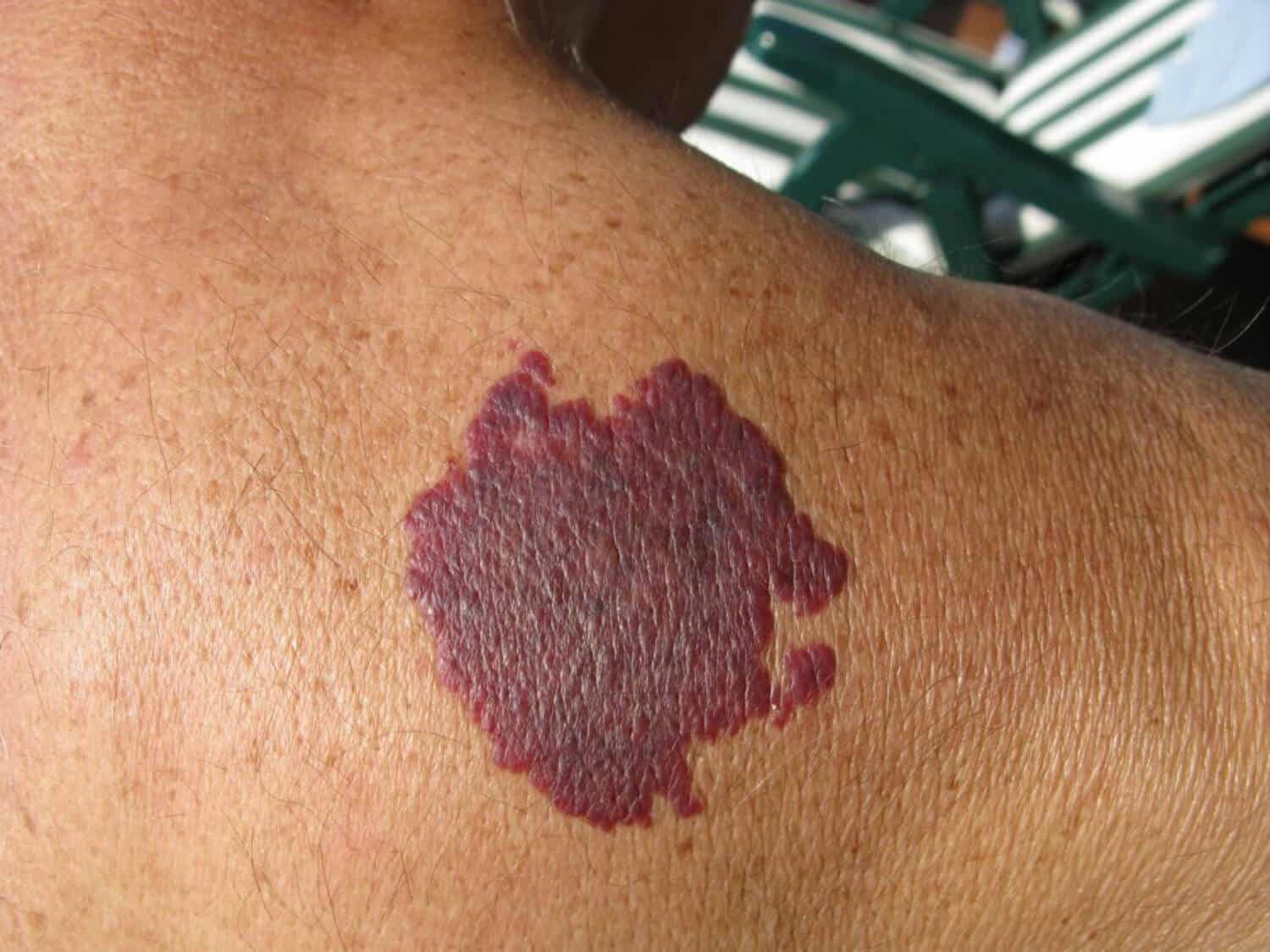 A large purple spot on a person's back.