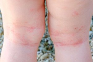 10 Questions About Atopic Dermatitis