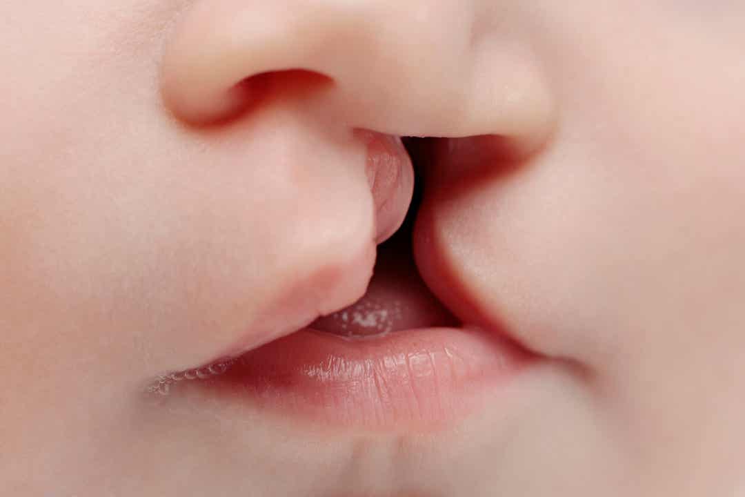 En baby med leppespalte og ganespalte.