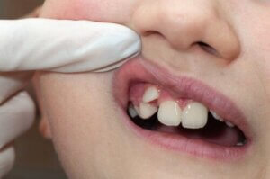 Bite Problems in Children: What You Should Know