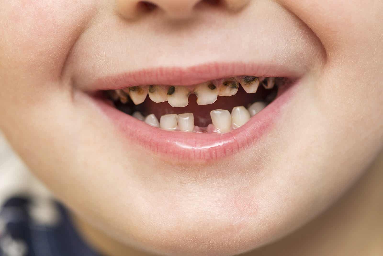 Dreng med huller i tænderne