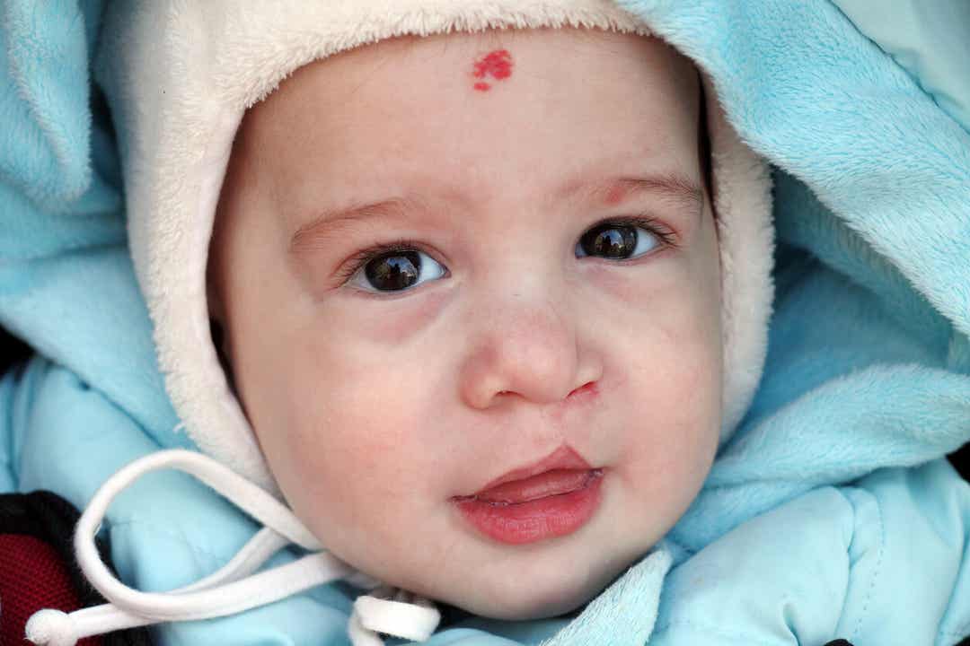 A baby born with a cleft lip who's undergone surgery to correct it.