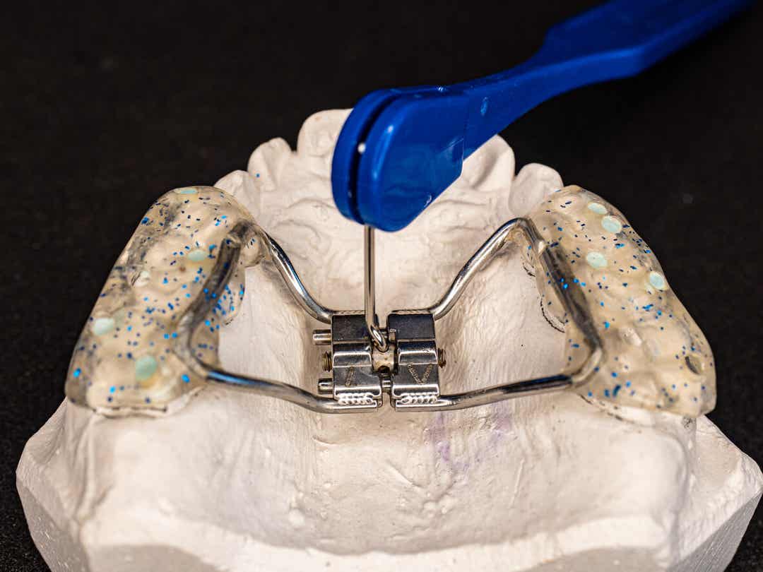 Een tandheelkundig apparaat op een gipsen mal.
