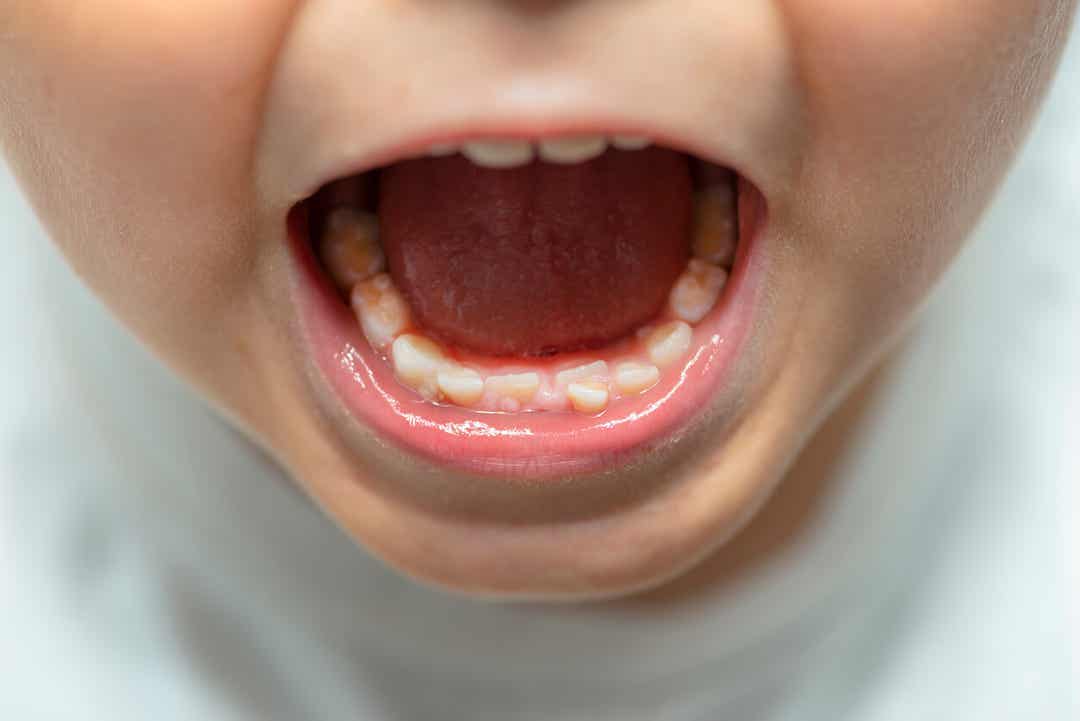 Verkeerd doorgekomen tanden bij kinderen