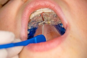 Ogival or High-Arched Palate in Children