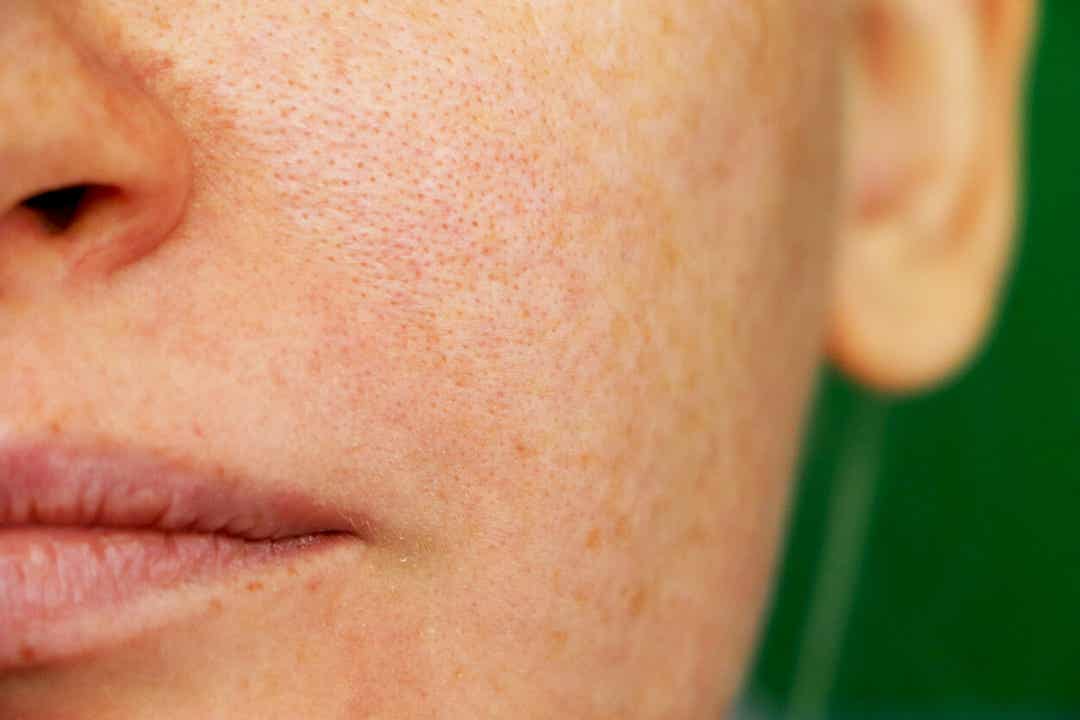 A woman with melasma on her face.