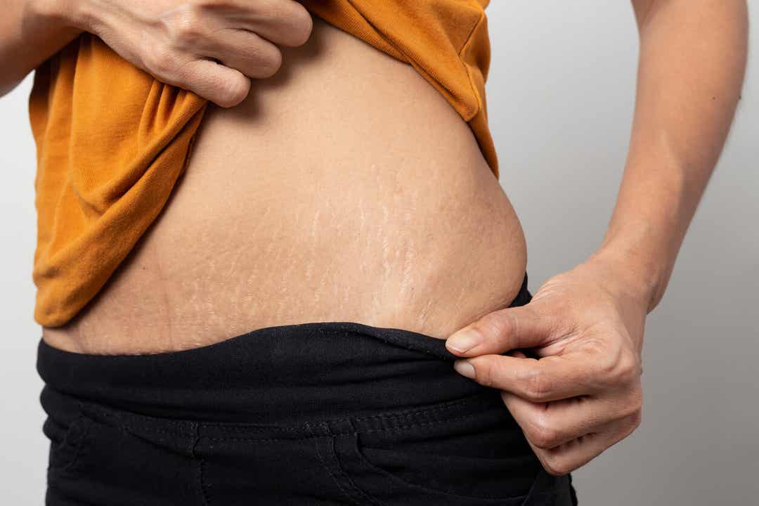 A woman with stretchmarks on her abdomen.