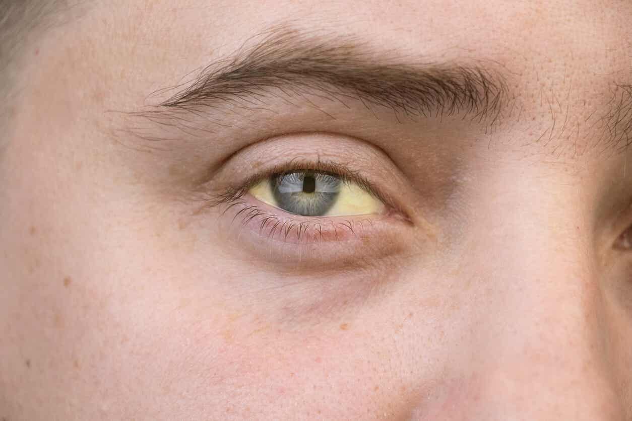 Yellow eyes due to hepatitis. 