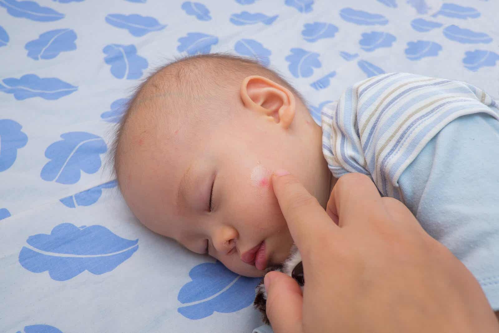 A parent applying cream to a bite on her baby's face.