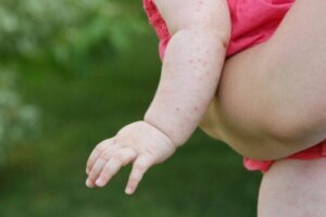 Scabies in Babies: Symptoms, Causes, and Treatment