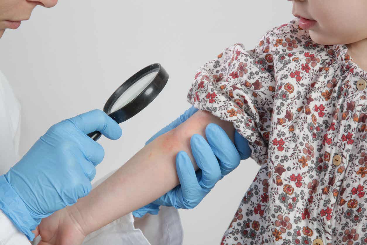 En läkare inspekterar utslag på ett barns barns arm.