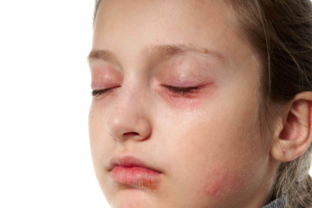 A chid with red around her eyes, chapped lips, and skin irritation.