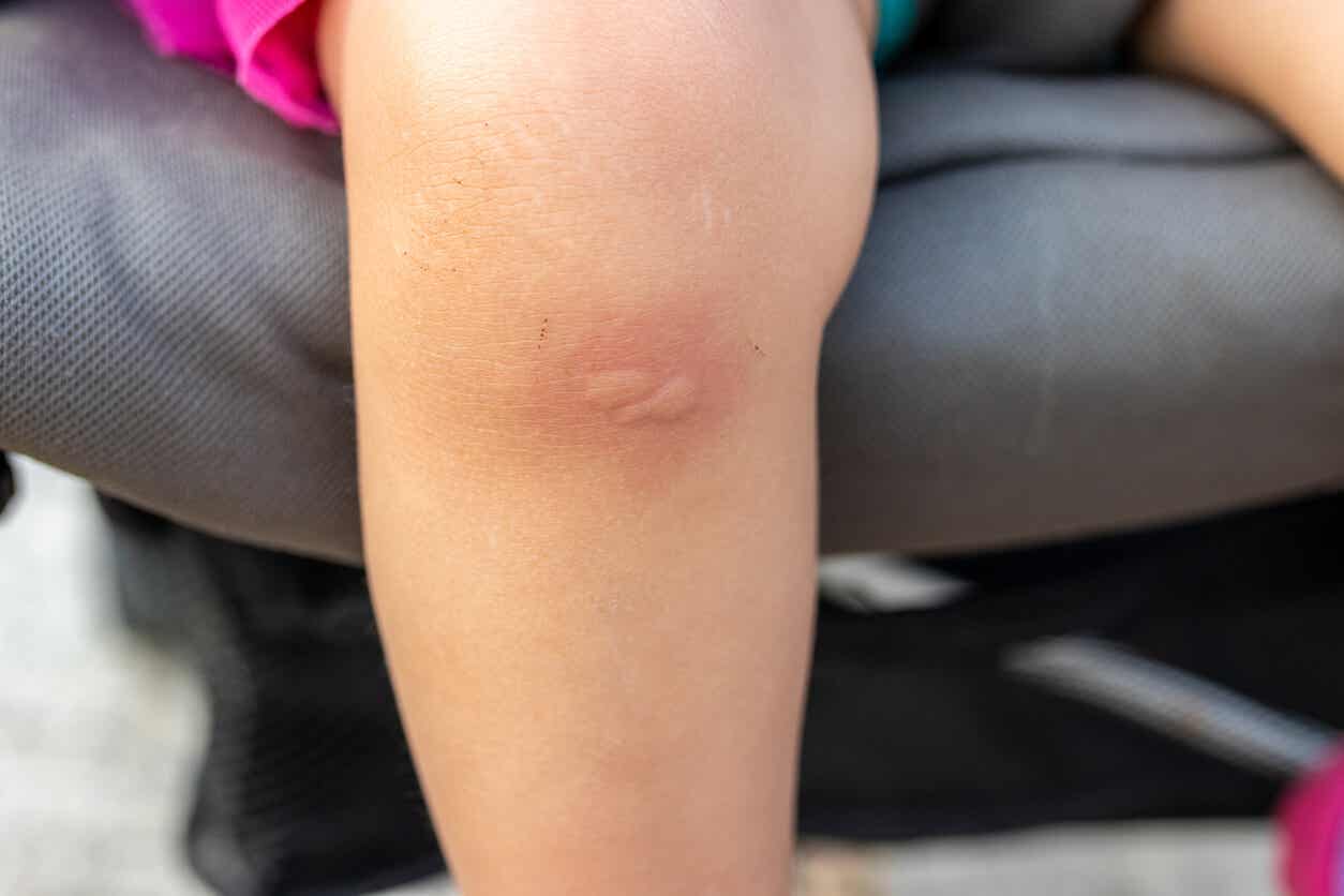 Een peuter met muggenbeten op haar knie.