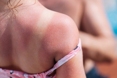 Sunburn in Children: Why Is It So Dangerous?