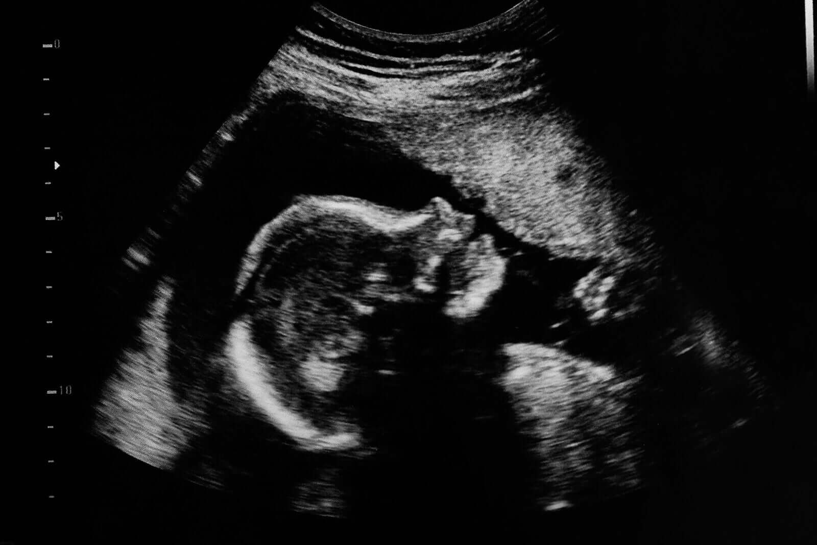 An ultrasound of a baby.