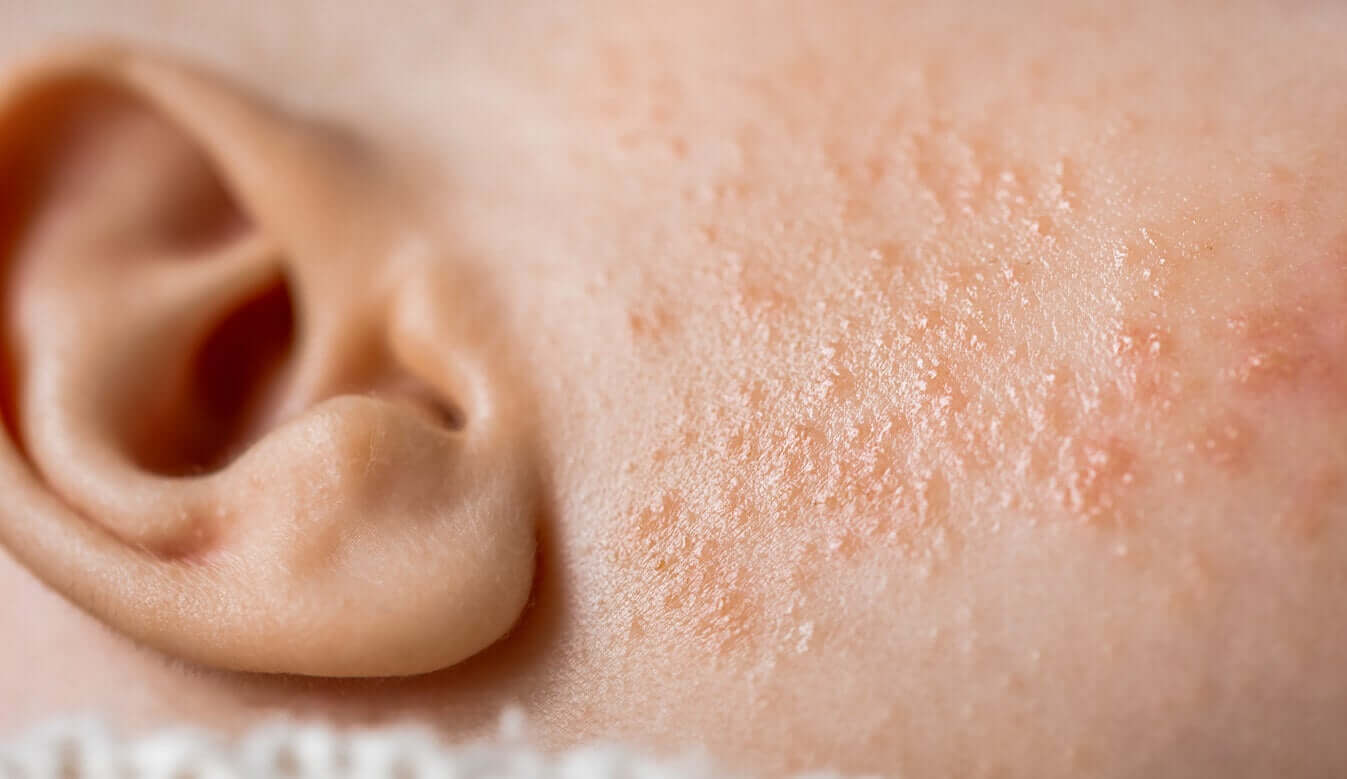 A child with infant acne.