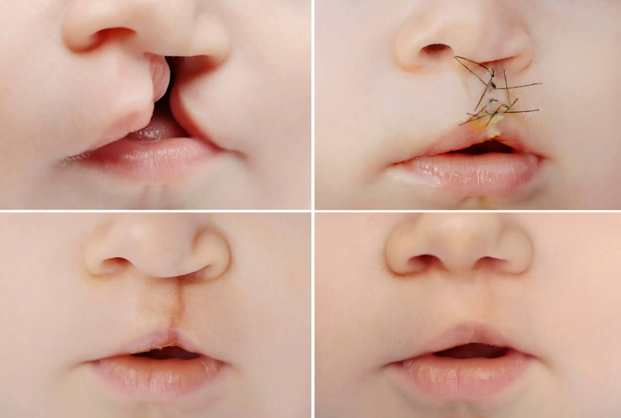 A child with cleft lip and palete before and after correction.