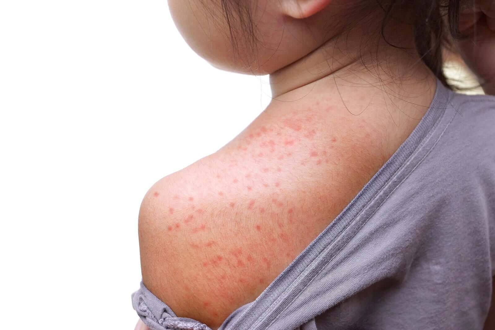 A young girl with red spots on her back and shoulders.