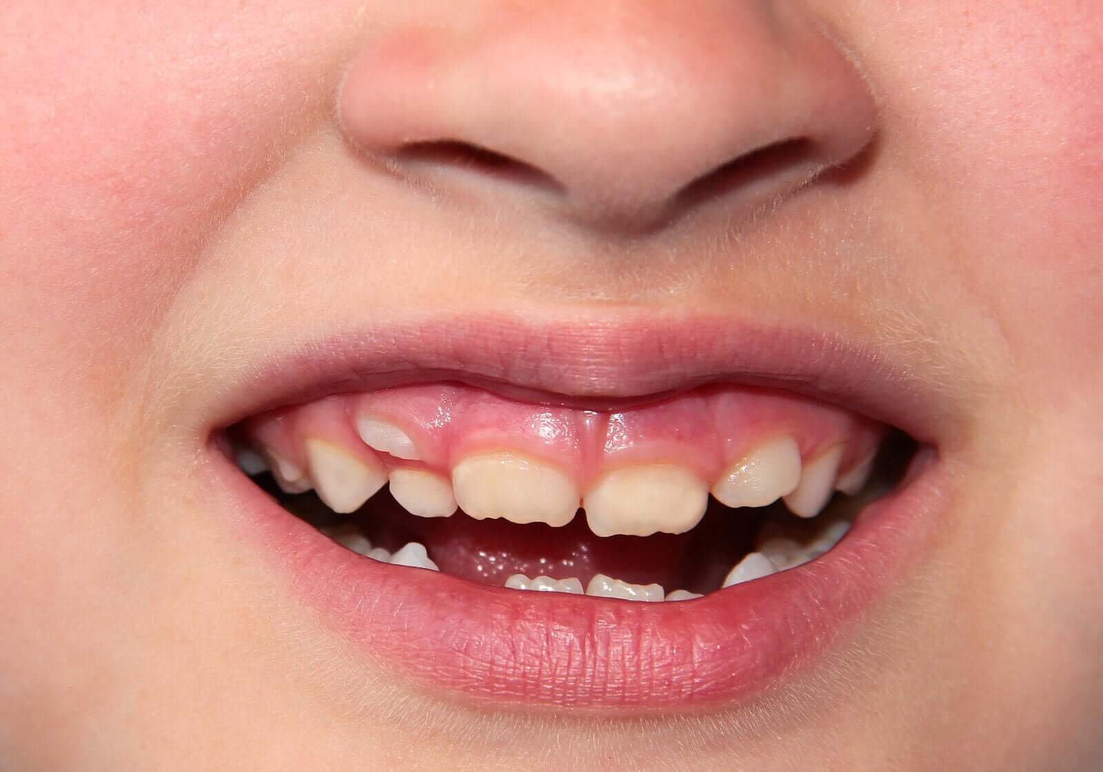 A child with a double row of teeth.