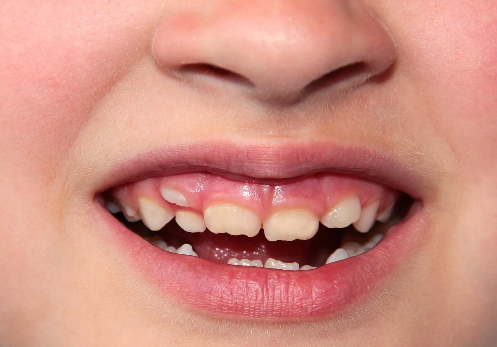 Teeth Row Double Row of Teeth in Children: What To Do?