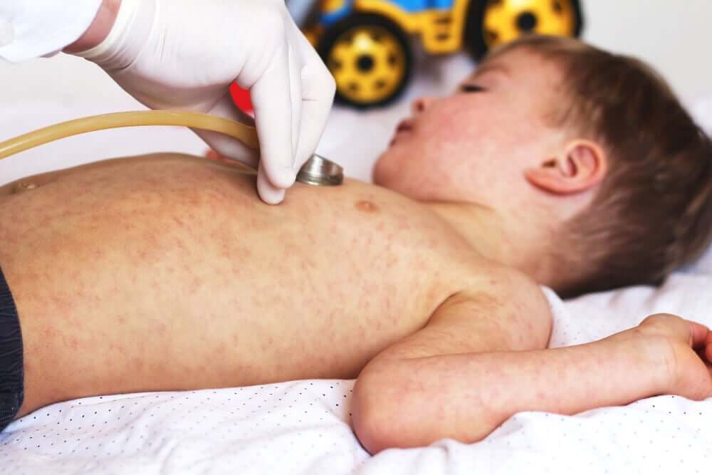 A doctor examining a child covered in red spots.