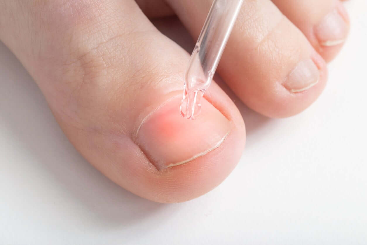 An infected toe nail and a liquid dropper.