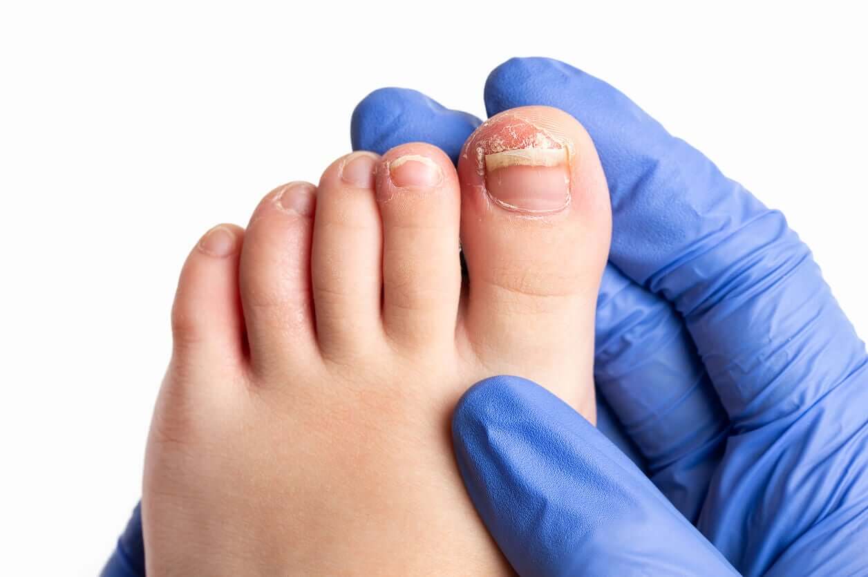 A child with a toe nail fungus.
