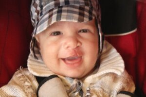 The Treatment of Cleft Lip