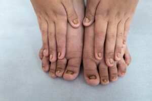 Color Changes in Children's Nails: What Do They Mean?