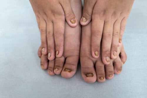 Color Changes in Children's Nails: What Do They Mean?
