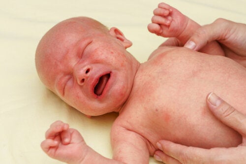 Petechiae in Babies: Causes, Symptoms, and Treatment