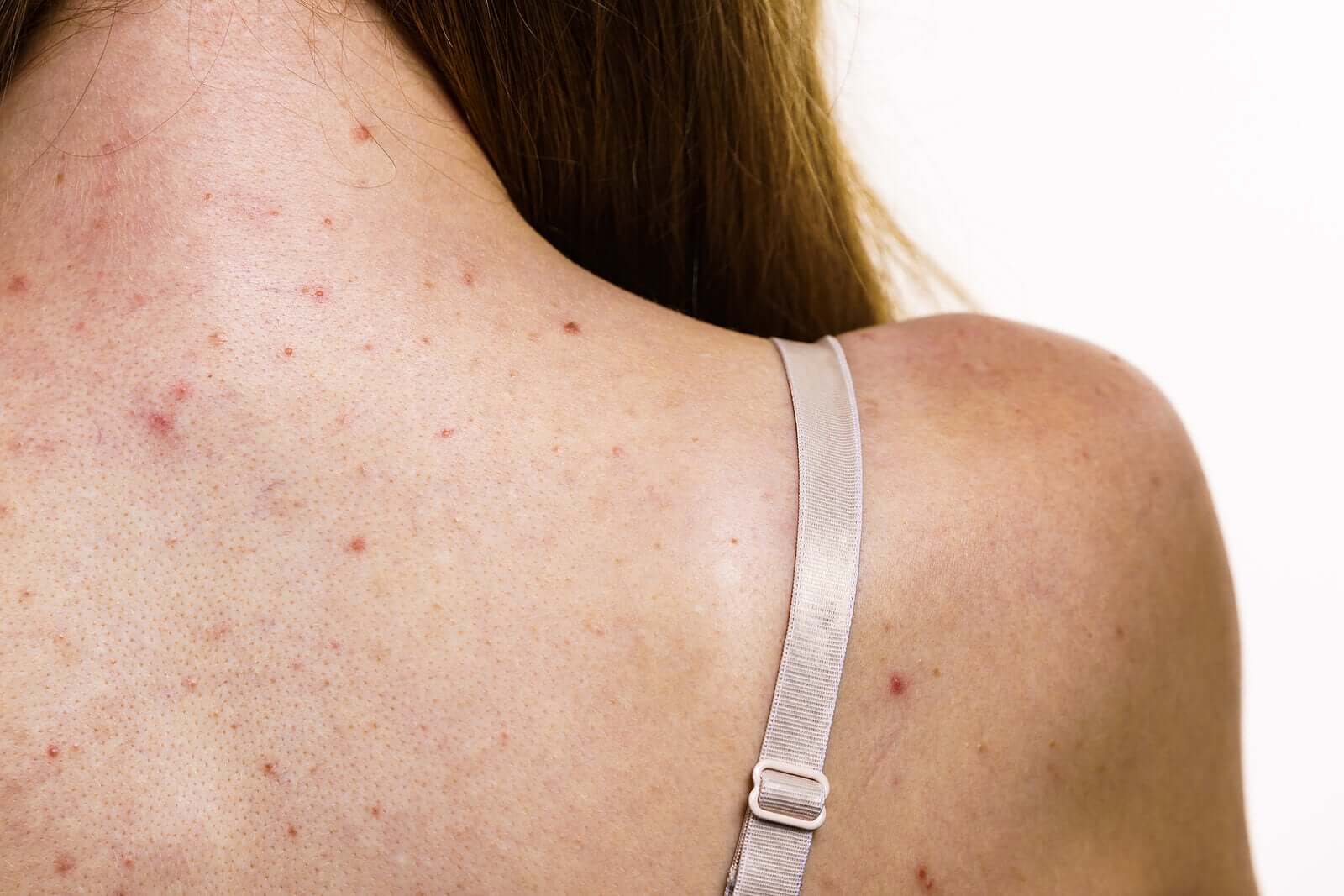 A woman with acne on her back.
