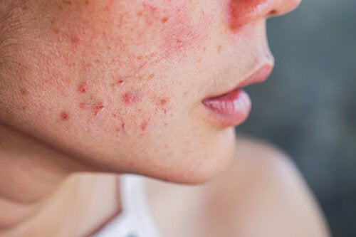 10 Home Remedies Against Acne During Pregnancy