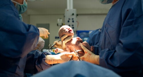 Cesarean Sections Continue to Rise, According to the WHO